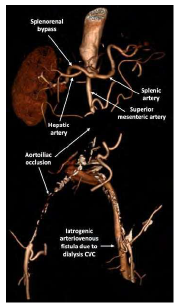 Redefining late renal artery revascularization - splenorenal bypass in ...