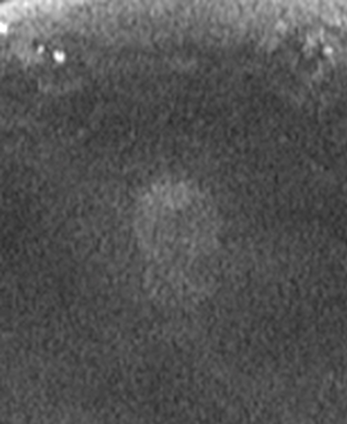 ARP Case Report nº 22: Apical Anterior Prostate Lesion