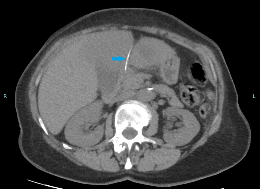 Fish Bone Perforation: A Rare Cause of Liver Abscess
