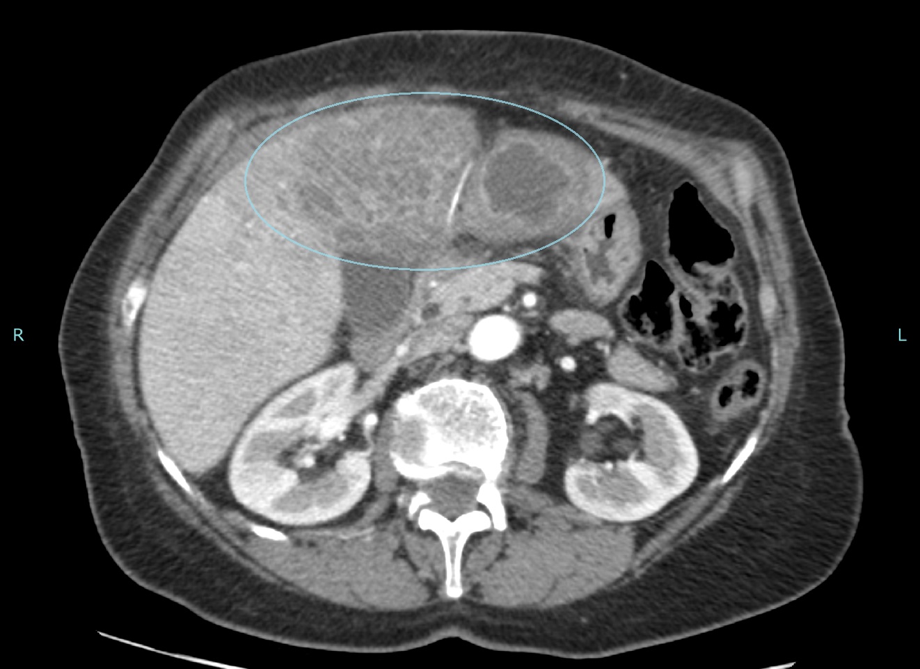 Fish Bone Perforation: A Rare Cause of Liver Abscess