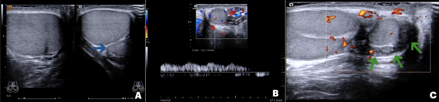 Polyorchidism: A Case Report and Review of the Literature