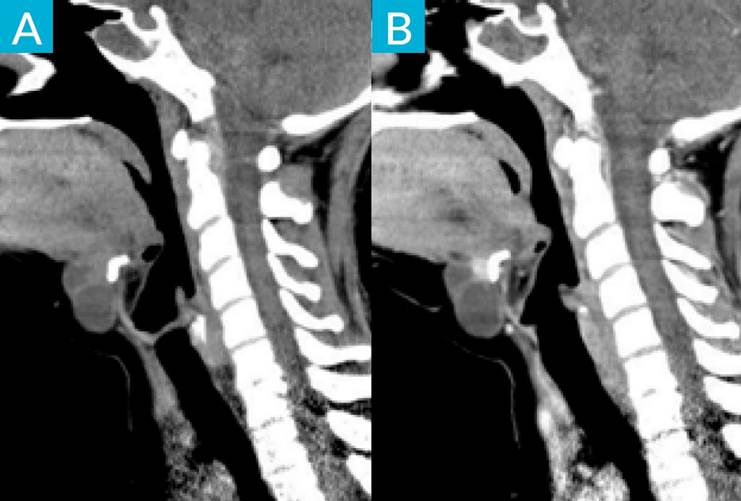 Papillary Carcinoma in a Thyroglossal Duct Cyst