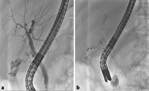 Endoscopic Management of Symptomatic Duodenal Duplication Cysts: Two ...