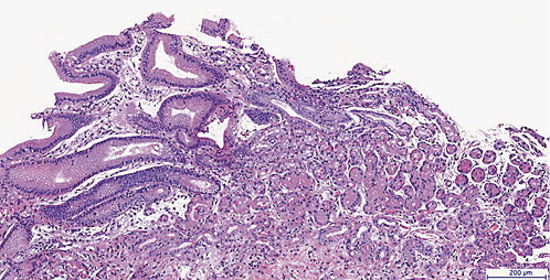A Rare Cause of Food Impaction: Heterotopic Gastric Mucosa