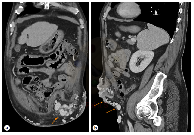 Transvenous Obliteration Procedure in the Management of Parastomal ...