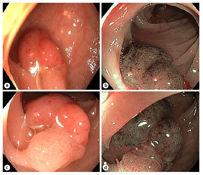 Advanced Imaging in Gastrointestinal Endoscopy: A Literature Review of ...