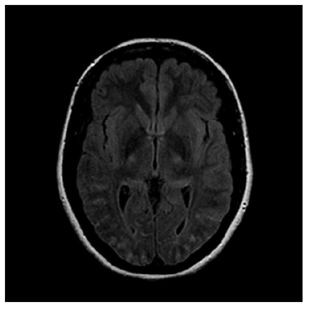 PRES in eclampsia - Two clinical cases