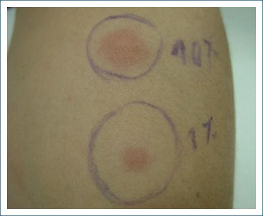A case of autoimmune progesterone dermatitis
