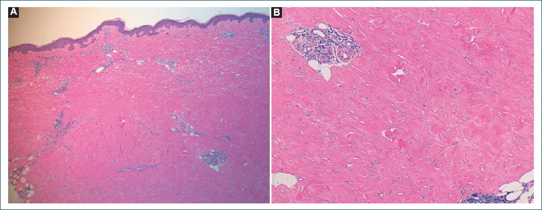 Radiation-induced morphea: an uncommon entity