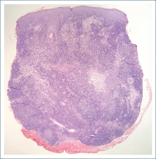 Plect Sporotrichoid leishmaniasis