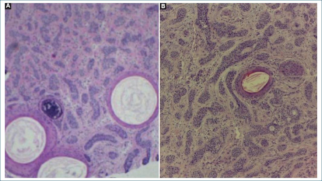 Desmoplastic trichoepithelioma on the face mimicking basal cell ...