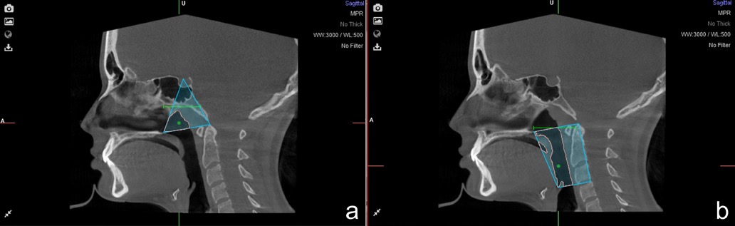 Correlation between the upper airway volume and Ricketts’ facial ...