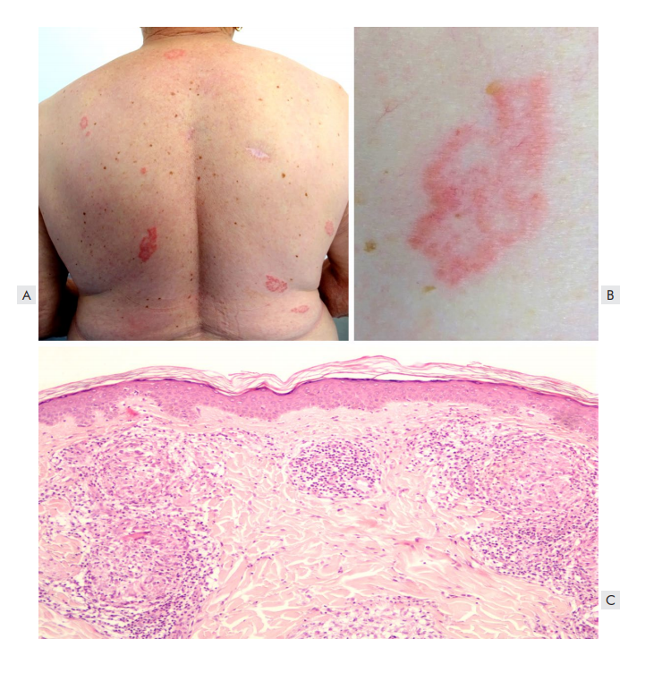 Non Specific Rash Cutaneous Adverse Events of Targeted Therapies and Immune-Checkpoint ...